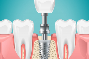 Dental Implant Whittier